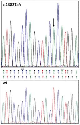 A Novel ALAS2 Missense Mutation in Two Brothers With Iron Overload and Associated Alterations in Serum Hepcidin/Erythroferrone Levels